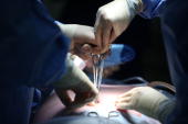 gall bladder removal keyhole surgery
