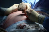gall bladder stone removal surgery