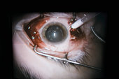 suffering cystoid macular edema 