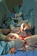 abdominal perineal resection