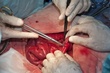 colostomy  colon removal surgery