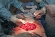 stoma reversal surgery