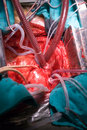 minimally invasive bypass surgery