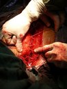 open heart valve replacement 