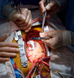 valve replacement surgery risks