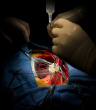 bypass heart surgery